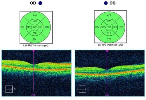 oct macular thickness measurements|what is normal foveal thickness.